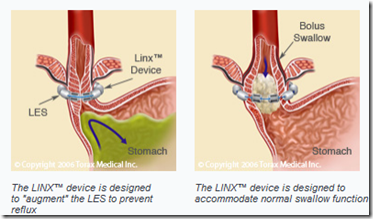 Implanted Medical Device for GERD (Gastroesophageal Reflux Disease) in ...